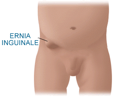 ernia